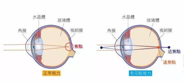 500度近視又老花，戴上美麗島多焦鏡煩惱全解決，46歲的周先生樂(lè)壞了